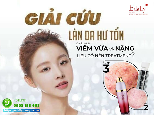 Da bị mụn viêm vừa và nặng, liệu có nên treatment hay không?