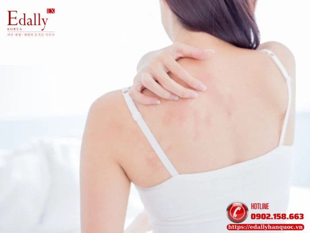 Da body bị nổi mẩn đỏ sau khi làm sạch bằng sữa tắm