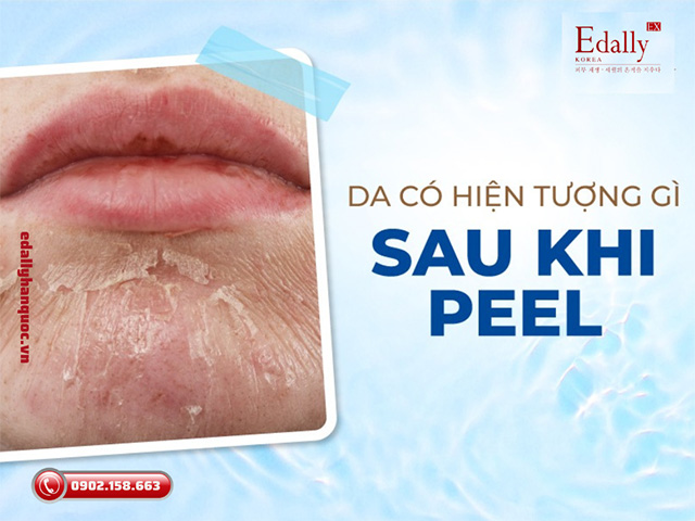 Da có hiện tượng gì sau khi thực hiện Peel da?