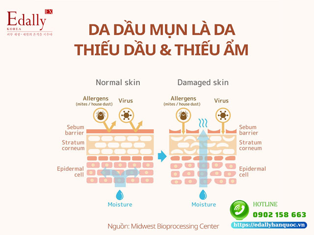 Da dầu mụn là da bị thiếu dầu và thiếu ẩm