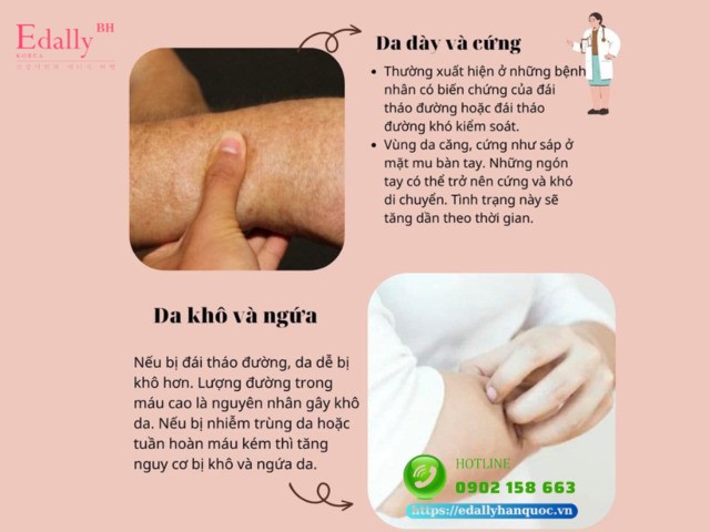 Da dày, cứng, khô và ngứa là dấu hiệu ở da cảnh báo bệnh đái tháo đường