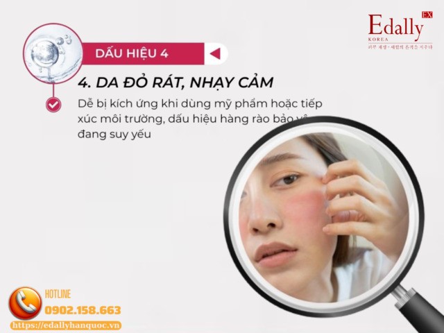 Da đỏ rát, nhạy cảm là dấu hiệu làn da stress vào thời điểm giao mùa Da đỏ rát, nhạy cảm là dấu hiệu làn da stress vào thời điểm giao mùa