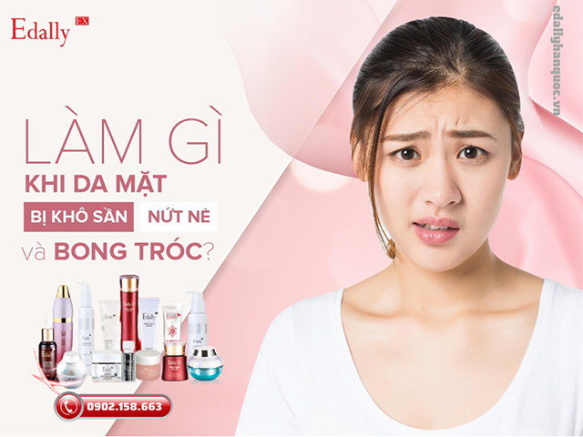 Da mặt bị khô sần, nứt nẻ, bong tróc thì phải làm sao?