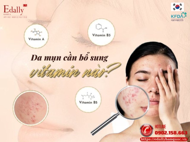 Da mụn cần bổ sung vitamin nào để cải thiện tình trạng da hiệu quả?