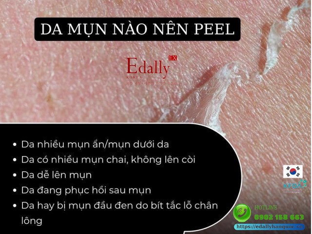 Da bị mụn loại nào thì nên peel da?