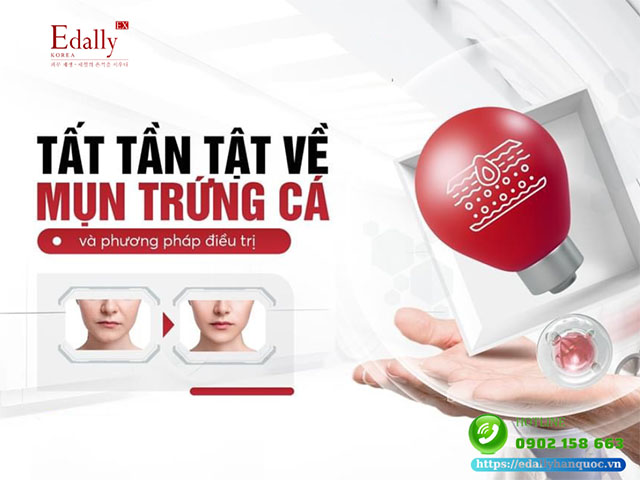 Các Bước Chăm Sóc Cải Thiện Da Mụn Hiệu Quả