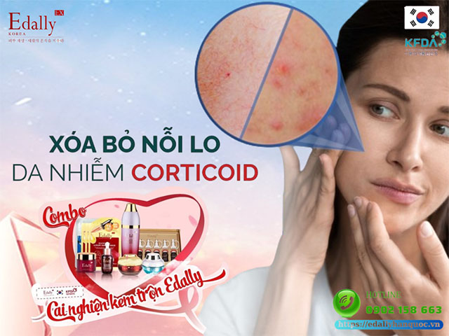 Da nhiễm Corticoid - Nỗi lo và cách giải quyết an toàn, hiệu quả