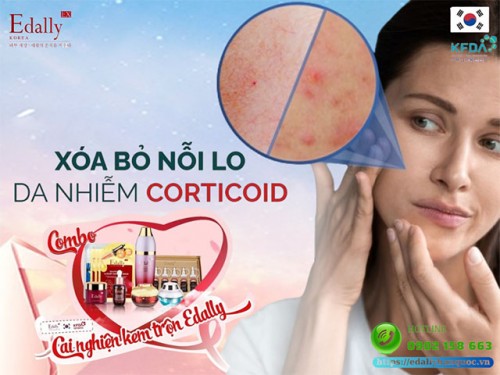 Da Nhiễm Corticoid Có Điều Trị Được Không Và Điều Trị Thế Nào?