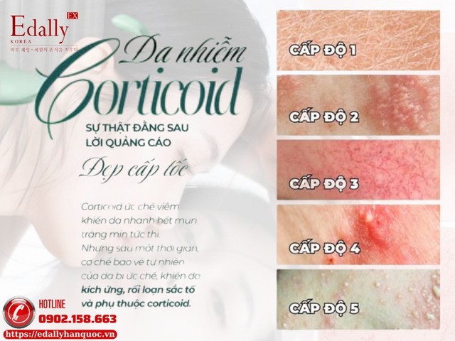 Da bị nhiễm corticoid và sự thật đằng sau lời quảng cáo đẹp cấp tốc