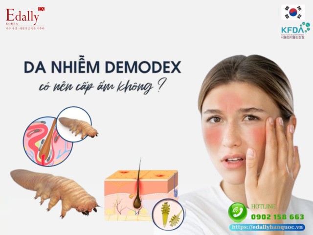 Da nhiễm demodex có nên cấp ẩm không?