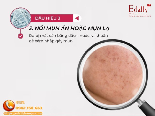 Nổi mụn ẩn hoặc mụn lạ là dấu hiệu làn da stress vào thời điểm giao mùa Nổi mụn ẩn hoặc mụn lạ là dấu hiệu làn da stress vào thời điểm giao mùa