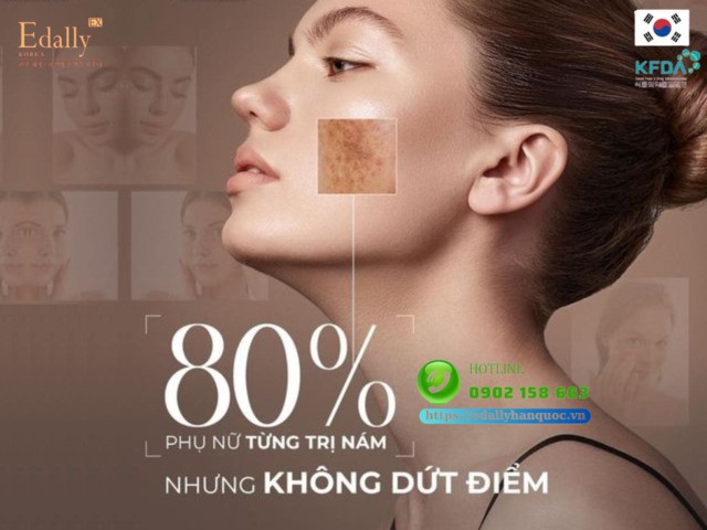 80% phụ nữ từng điều trị nám da nhưng không dứt điểm