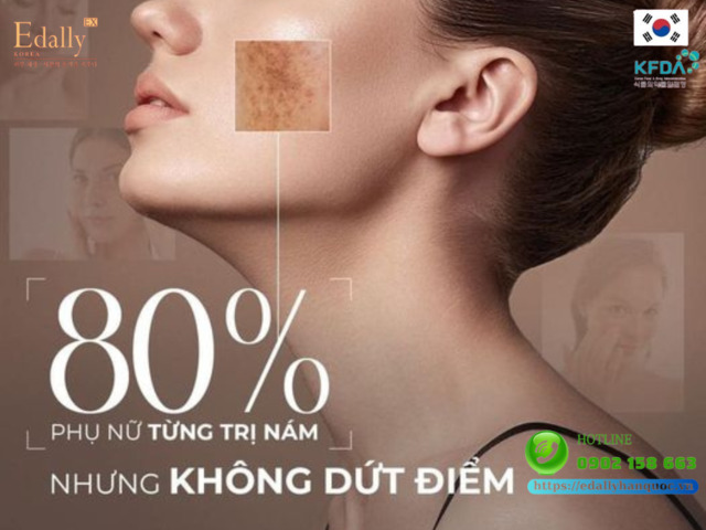 80% phụ nữ từng điều trị nám da nhưng không dứt điểm