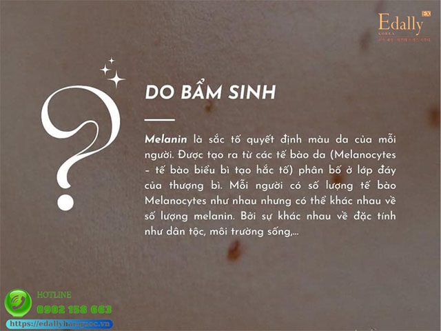 Da sạm xỉn màu do bẩm sinh