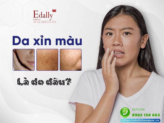 Da sạm xỉn màu nguyên nhân do đâu?