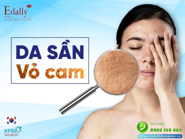 Sần da vỏ cam Cellulite - Nguyên nhân, dấu hiệu và cách phòng tránh hiệu quả