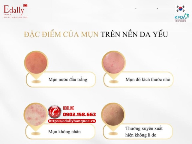 Mụn trên nền da yếu có đặc điểm gì?