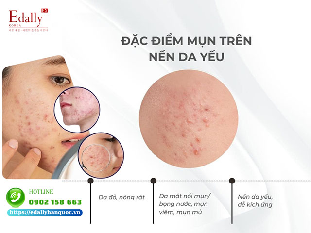 Các hình thái của mụn trên nền da yếu