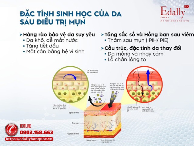 Đặc tính sinh học của làn da sau điều trị mụn