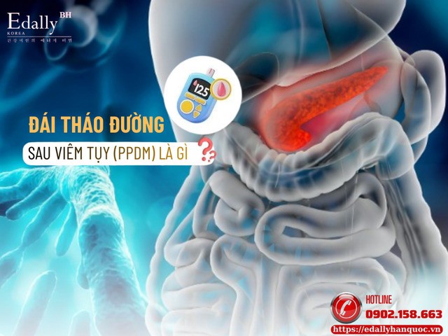 Đái tháo đường sau viêm tụy (Postpancreatitis Diabetes Mellitus - PPDM)