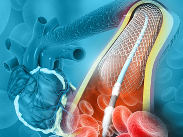 Đặt stent máu động mạch vành rất tốn kém và nhiều nguy cơ rủi ro