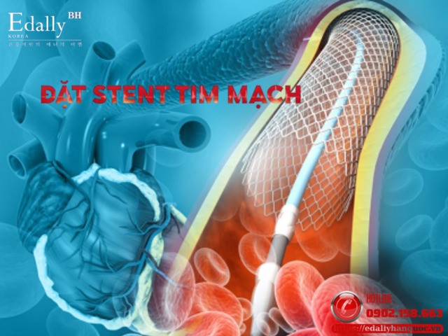 Tại sao những người mắc bệnh tim hay phải đặt stent mà lại không dùng thuốc chữa?