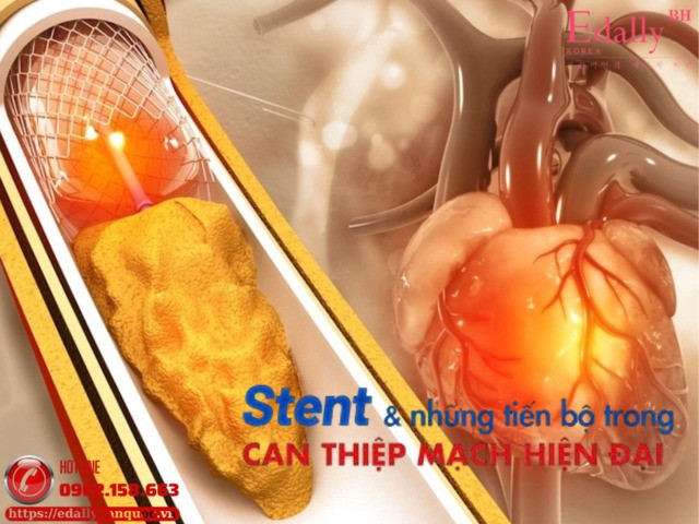 Đặt stent và những tiến bộ trong can thiệp tim mạch hiện đại