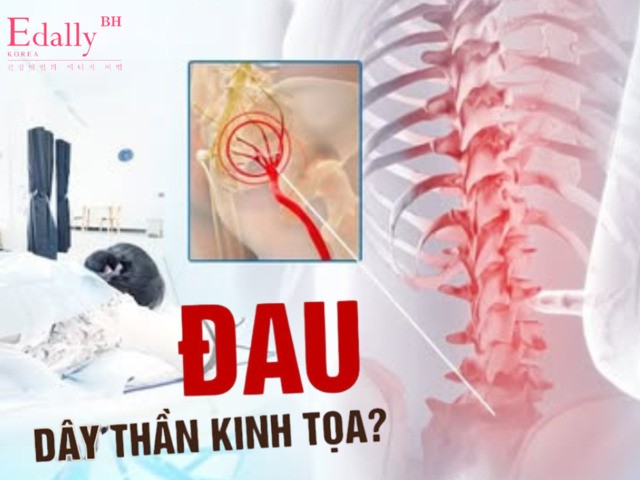 Đau thần kinh tọa là chứng đau thần kinh thường gặp