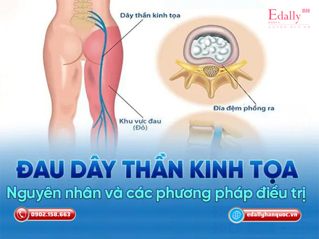 Nguyên nhân, triệu chứng và cách điều trị đau thần kinh tọa