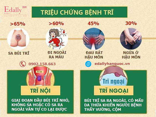 Dấu hiệu của bệnh trĩ