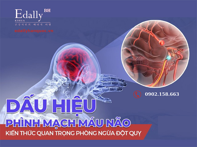 Dấu hiệu nhận biết bệnh túi phình động mạch não