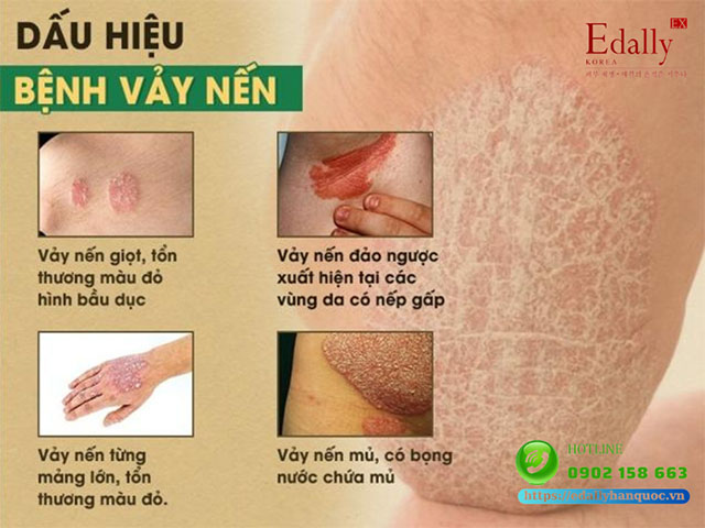 Dấu hiệu nhận biết bệnh vảy nến