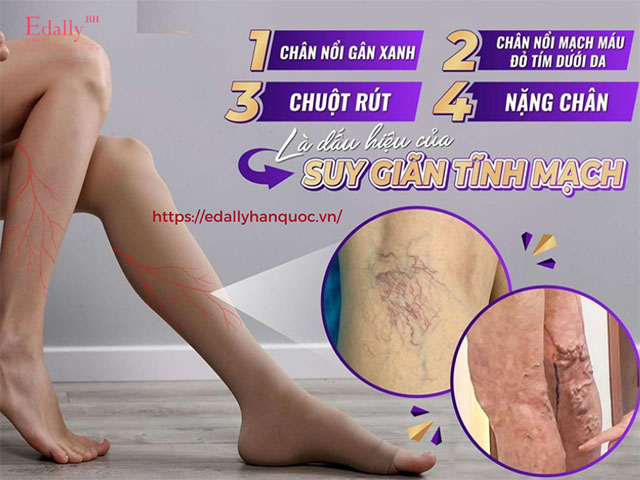 Dấu hiệu của bệnh suy giãn tĩnh mạch chân