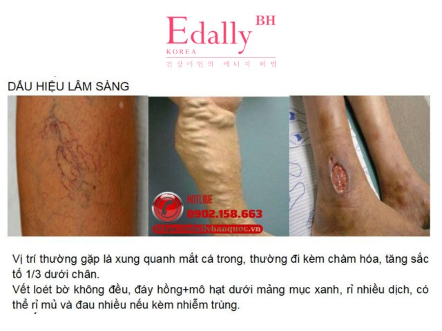 Dấu hiệu nhận biết và vị trí thường gặp của loét tĩnh mạch