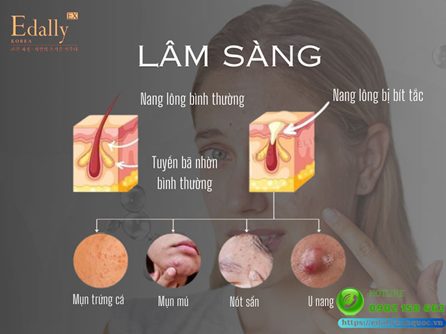 Triệu chứng lâm sàng của mụn trứng cá trên nền da nhạy cảm