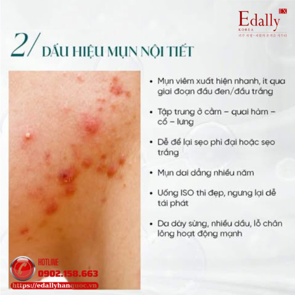 Dấu hiệu nhận biết mụn nội tiết