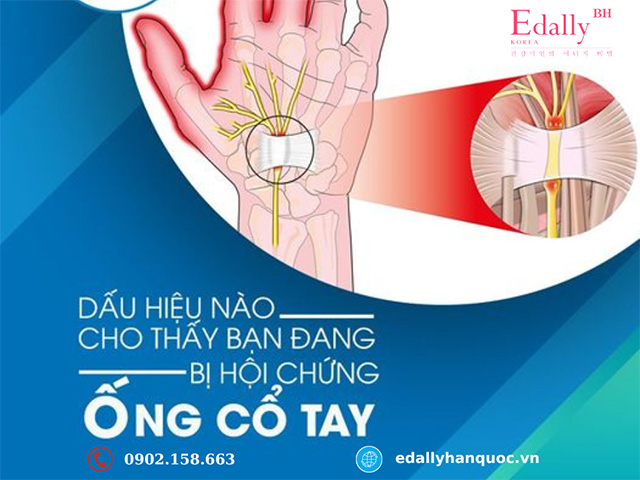 Dấu hiệu nào cho thấy bạn đang bị hội chứng ống cổ tay?