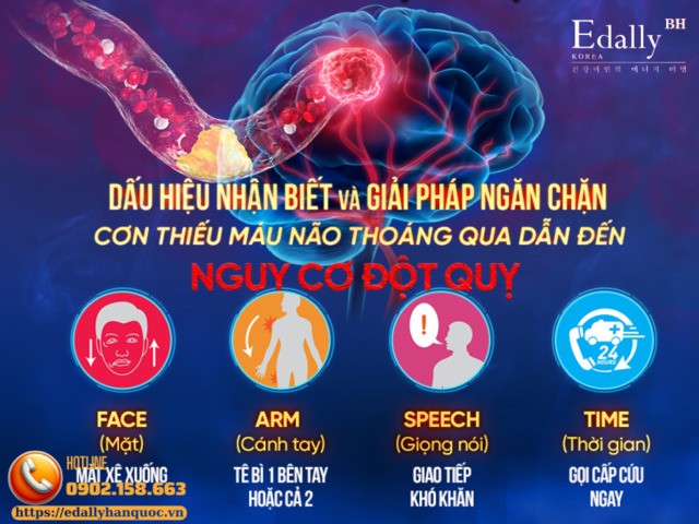 Dấu hiệu nhận biết bệnh TIA - Cơn thiếu máu não thoáng qua có thể dẫn đến đột quỵ