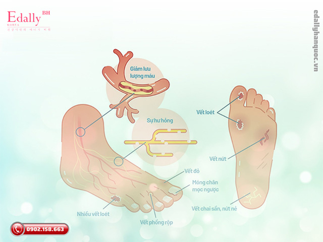 Dấu hiệu nhận biết biến chứng bàn chân đái tháo đường