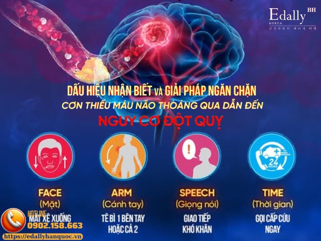 Dấu hiệu nhận biết cơn đột quỵ thoáng qua (TIA) Dấu hiệu nhận biết cơn đột quỵ thoáng qua (TIA)