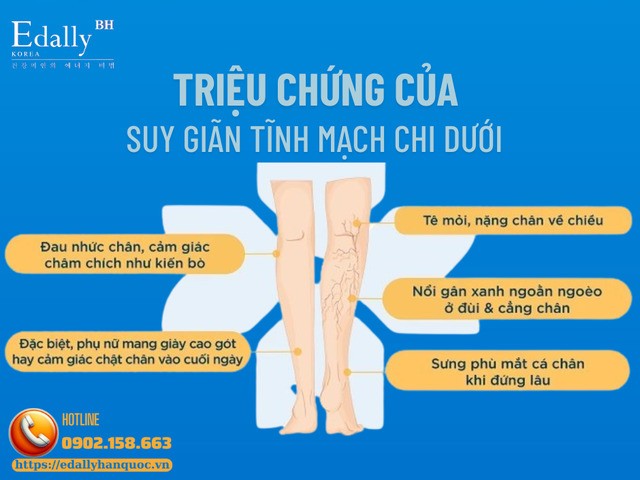 Triệu chứng của suy giãn tĩnh mạch chi dưới