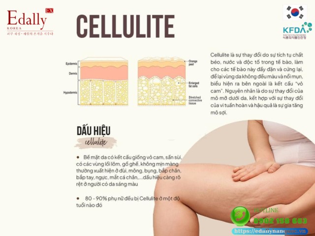 Dấu hiệu nhận biết da sần vỏ cam Cellulite