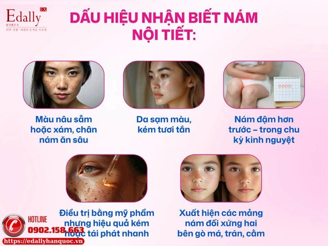 Những dấu hiệu nhận biết nám nội tiết