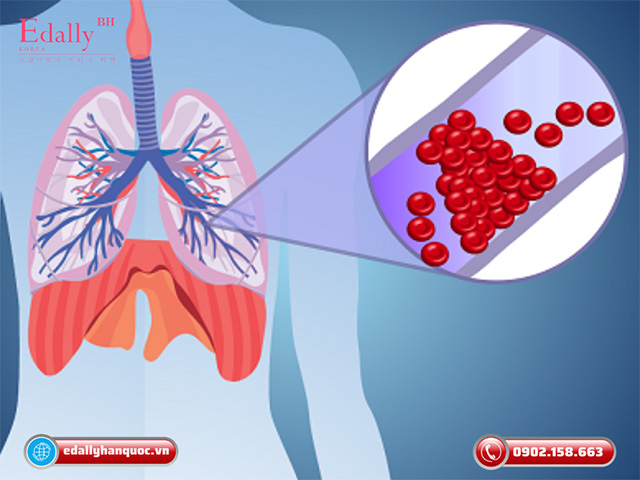 Dấu hiệu nhận biết nhồi máu phổi lag gì?