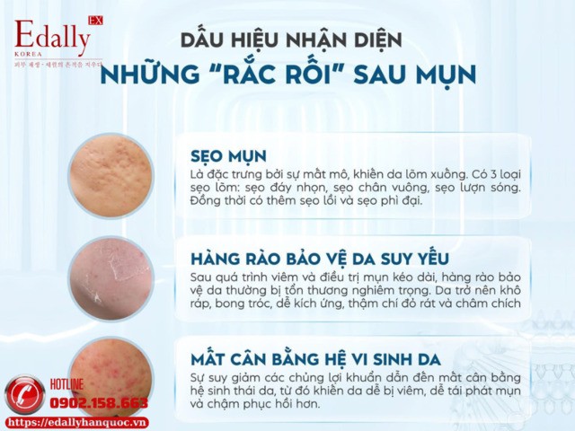 Dấu hiệu nhận diện những rắc rối thường gặp sau mụn