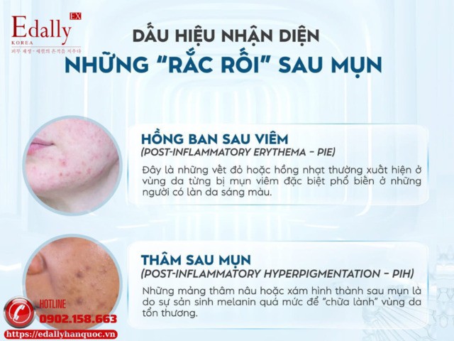 Dấu hiệu nhận diện những rắc rối sau mụn thường gặp