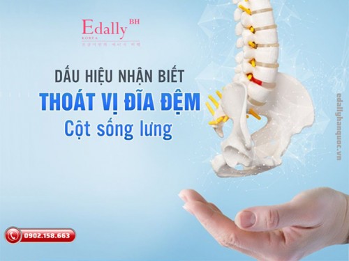 Thoát Vị Đĩa Đệm Cột Sống Lưng Có Chữa Được Không?