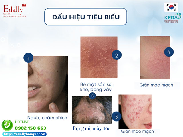 Dấu hiệu nhận biết viêm da do Demodex