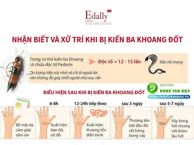 Dấu hiệu nhận biết viêm da tiếp xúc kích ứng cho kiến ba khoang