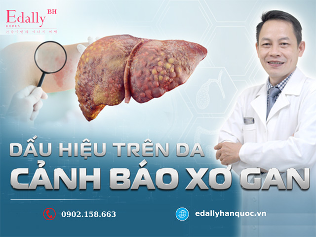 Dấu Hiệu Trên Da Cảnh Báo Bệnh Xơ Gan